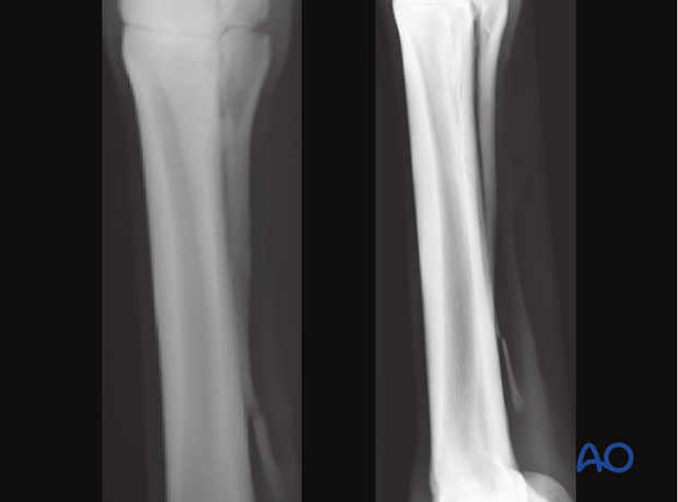 Distal fractures of the metacarpals/-tarsals II and IV
