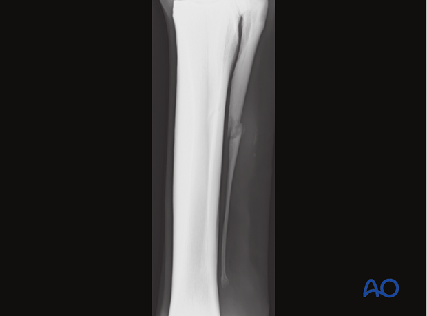 H87_D02_x10 Midbody fractures of the metacarpals/-tarsals II and IV
