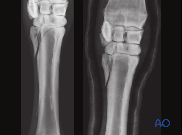 H87_D02_x30 Midbody fractures of the metacarpals/-tarsals II and IV