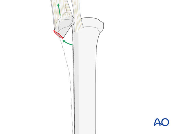 Proximal splint bone fracture - resection