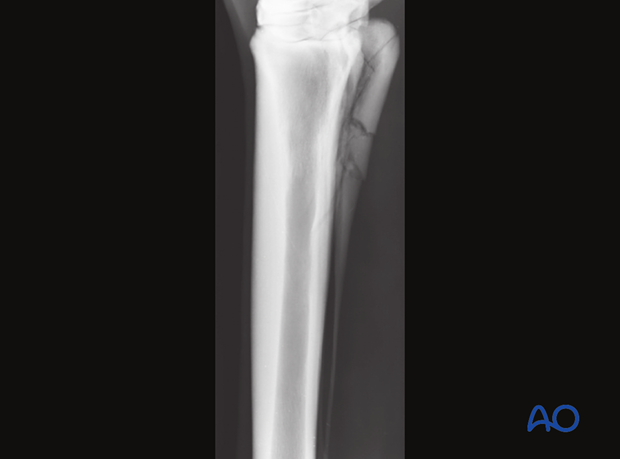 H87_D03_x20 Proximal fractures of the metacarpals/-tarsals II and IV