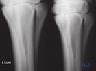 III metaphyseal proximal incomplete
