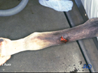 III diaphyseal multifragment
