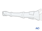 Distal splint bone fracture - nonsurgical treatment