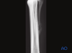 II IV midbody