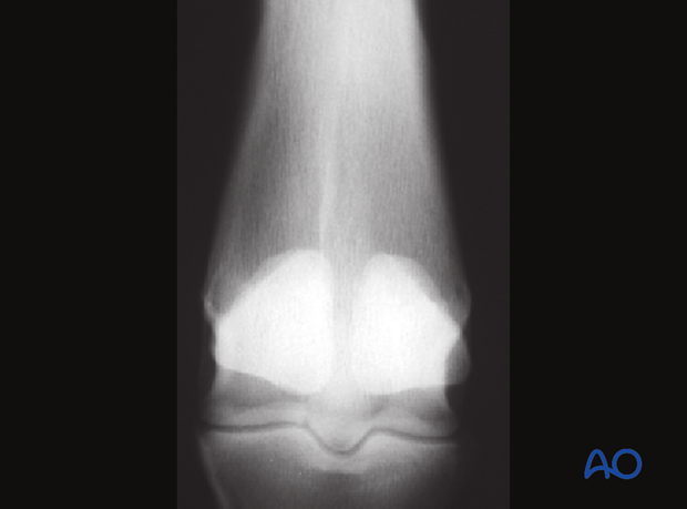 Medial incomplete condylar fracture - nonsurgical treatment