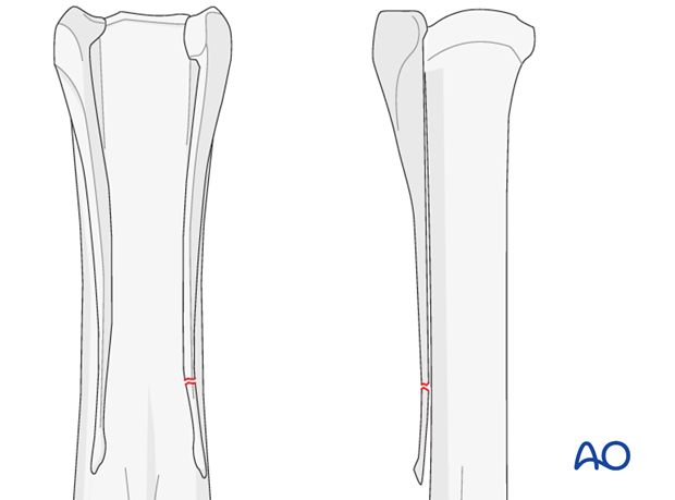 Distal fractures of the metacarpals/-tarsals II and IV