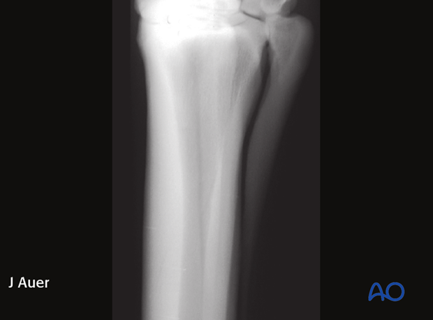 nonsurgical treatment