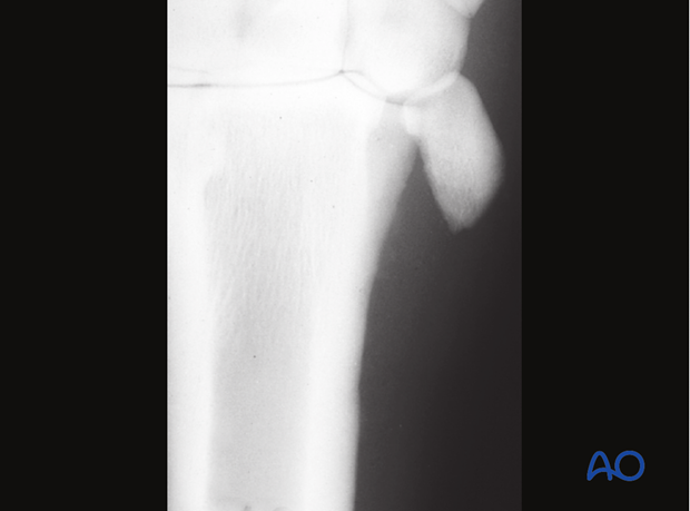 Dislocation of proximal stump
