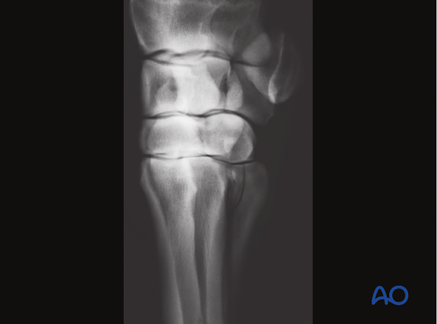 Alternative: Screw fixation for simple oblique fractures