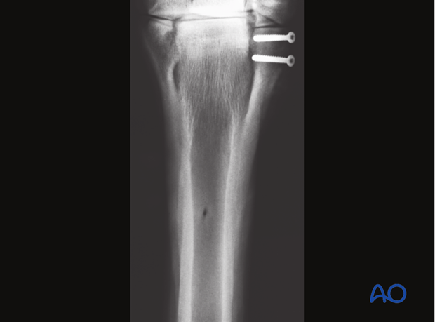 Alternative: Screw fixation for simple oblique fractures
