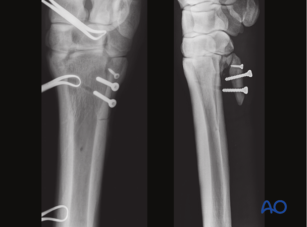Alternative: Screw fixation for simple oblique fractures