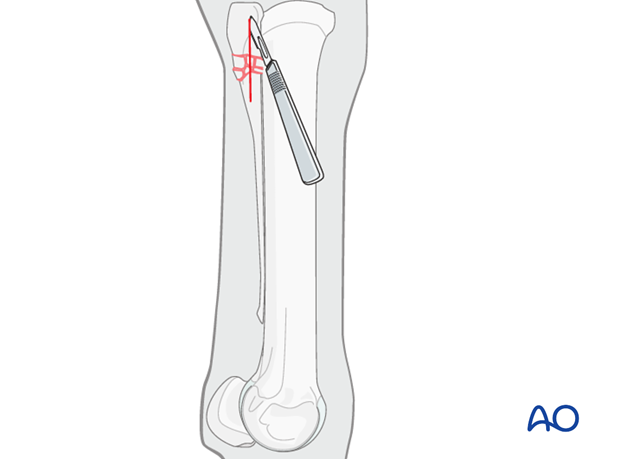 H87_O110_i105 Proximal splint bone fracture - approaches