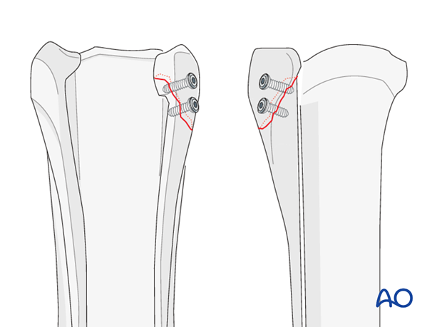 Alternative: Screw fixation for simple oblique fractures