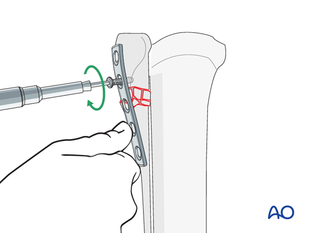 Application of the plate