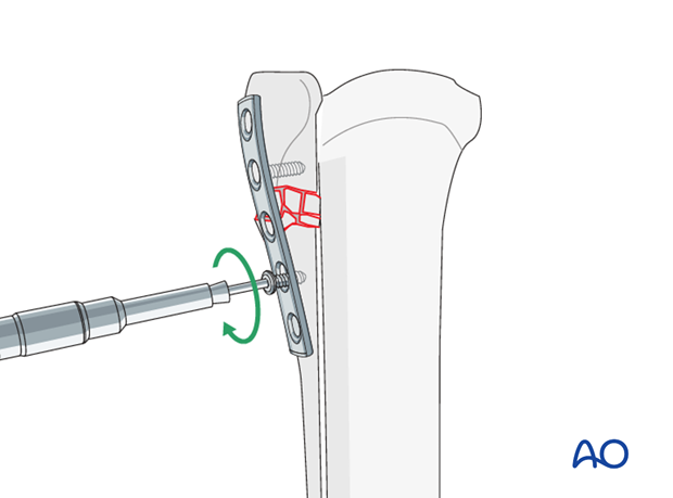 Insertion of the second screw