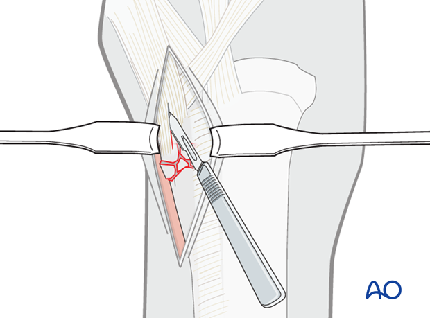 H87_O110_i205 Proximal splint bone fracture - approaches
