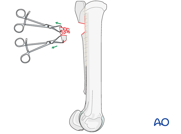 Proximal splint bone fracture - resection