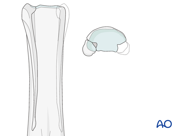 Proximal splint bone fracture - resection