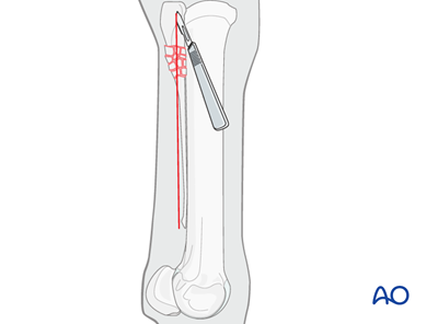 Resection for Metacarpals/-tarsals II and IV: Proximal fractures