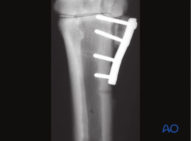 Proximal splint bone fracture - resection