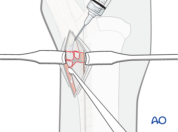 Proximal splint bone fracture - debridement