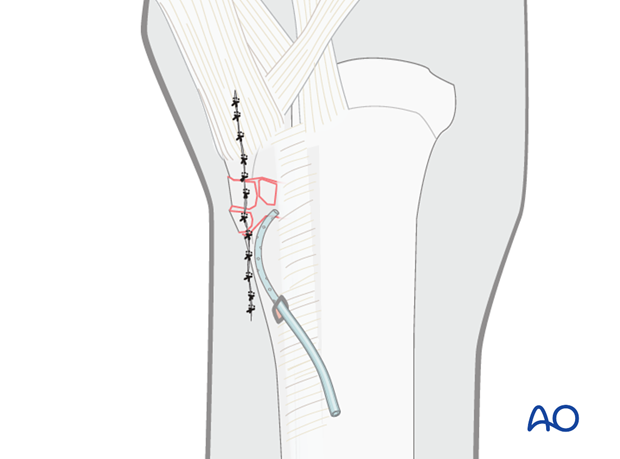 Proximal splint bone fracture - debridement