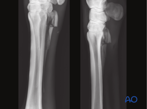 Proximal splint bone fracture - debridement
