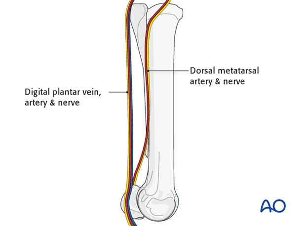 H87_O120_i100 Midbody splint bone fracture - resection