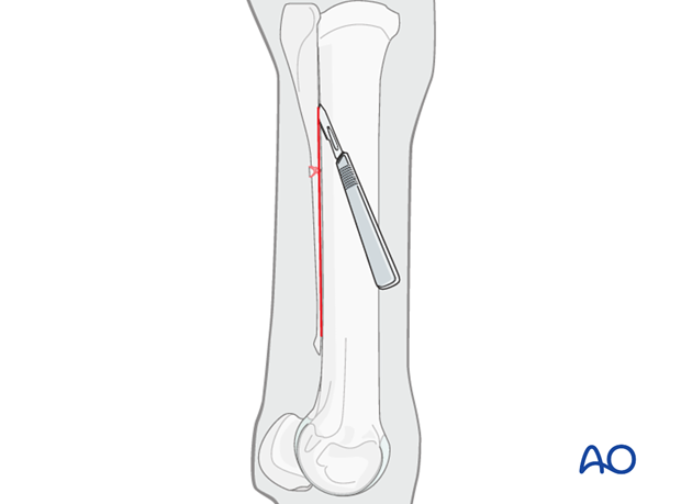 Proximal splint bone fracture - approaches