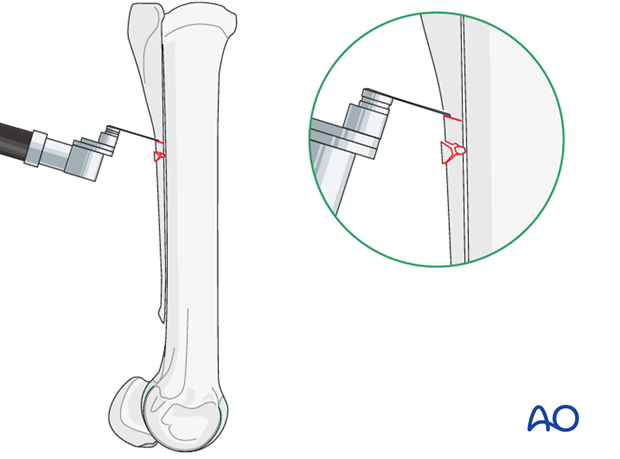 H87_O120_i200 Midbody splint bone fracture - resection