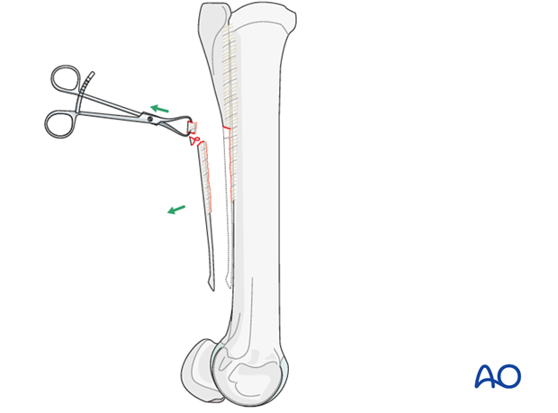 H87_O120_i210 Midbody splint bone fracture - resection