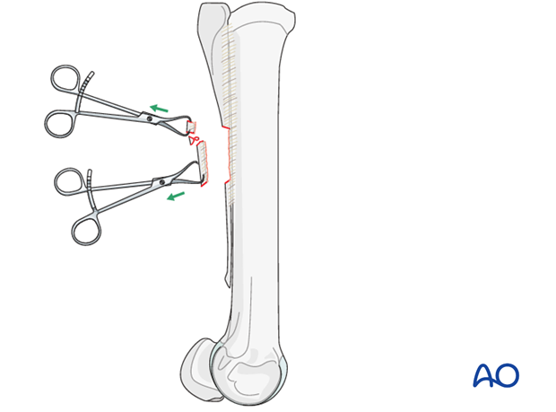 H87_O120_i220 Midbody splint bone fracture - resection