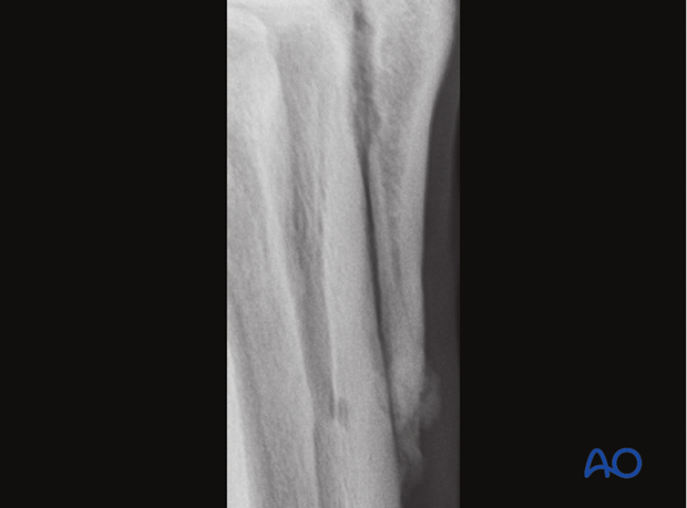 H87_O120_midbody_resect_x100 Midbody splint bone fracture - resection