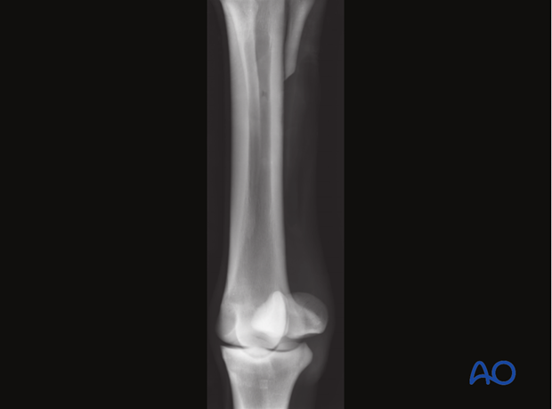 H87_O120_midbody_resect_x20 Midbody splint bone fracture - resection