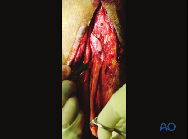 H87_O120_midbody_resect_x30 Midbody splint bone fracture - resection