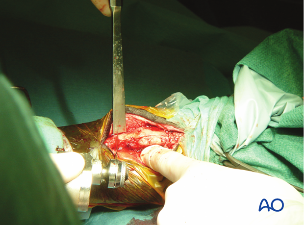 H87_O120_midbody_resect_x40 Midbody splint bone fracture - resection