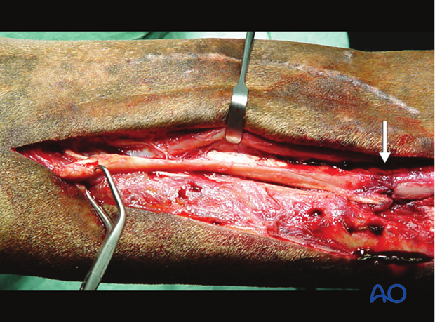 H87_O120_midbody_resect_x50 Midbody splint bone fracture - resection
