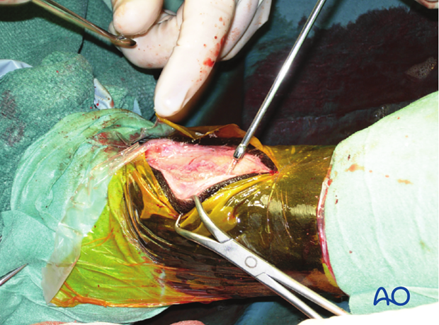 H87_O120_midbody_resect_x60 Midbody splint bone fracture - resection