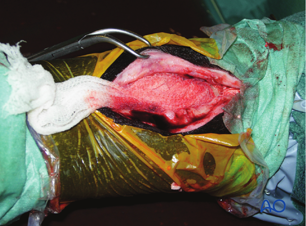 H87_O120_midbody_resect_x70 Midbody splint bone fracture - resection