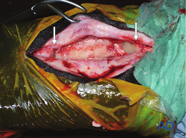 H87_O120_midbody_resect_x90 Midbody splint bone fracture - resection