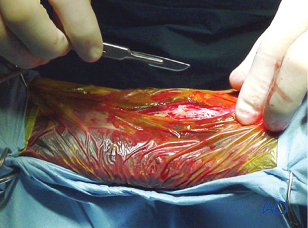 H87_O130_distal_resect_x10 Distal splint bone fracture - resection