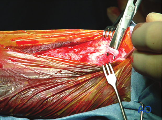 H87_O130_distal_resect_x20 Midbody and distal splint bone fractures - approaches