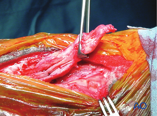 H87_O130_distal_resect_x30 Distal splint bone fracture - resection