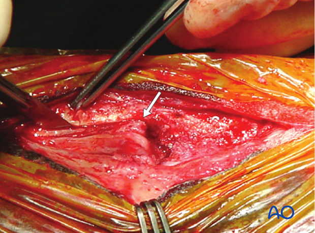 H87_O130_distal_resect_x40 Distal splint bone fracture - resection