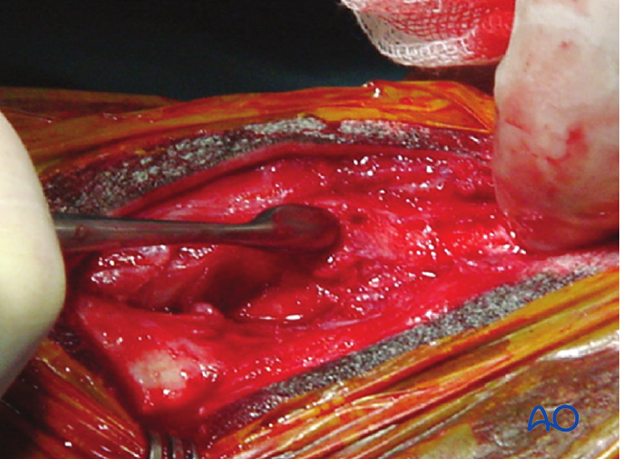 H87_O130_distal_resect_x50 Distal splint bone fracture - resection
