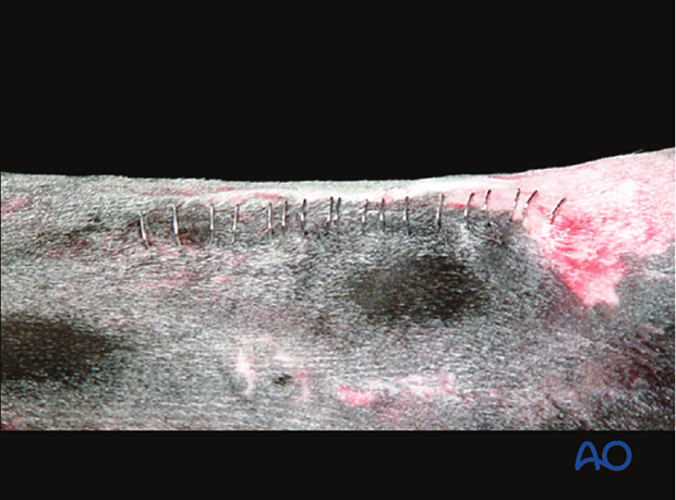 H87_O130_distal_resect_x60 Distal splint bone fracture - resection