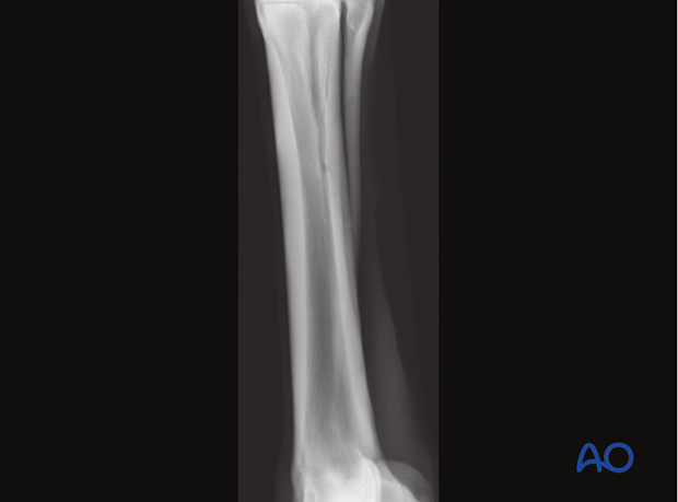 H87_O130_distal_resect_x70 Distal splint bone fracture - resection