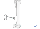Distal splint bone fracture - resection