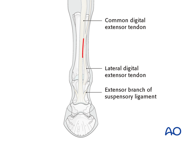 approach to mcmtiii diaphysis